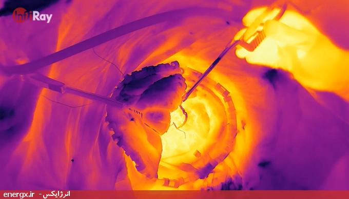 ترموگرافی مادون قرمز - دوربین حرارتی InfiRay - دوربین تصویربرداری حرارتی مورد استفاده در پزشکی مغز